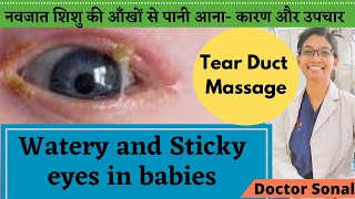 Watery and sticky eyes in babies  causes and Treatment Tear Duct Massage Doctor Sonal [upl. by Saxena]