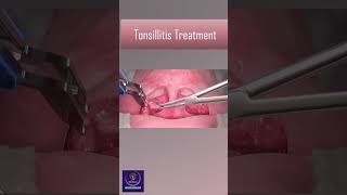 Tonsillitis Treatment With Heat Device tonsillitis [upl. by Olsen636]