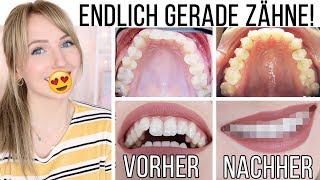 VORHERNACHHER SO sehen meine Zähne JETZT aus Meine Erfahrung mit Invisalign TheBeauty2go [upl. by Ahsea]