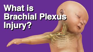 What is Brachial Plexus Injury [upl. by Nivak191]