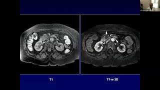 237 Le neoplasie pancreatiche  Prof Quaia e Prof Basile [upl. by Nadean]