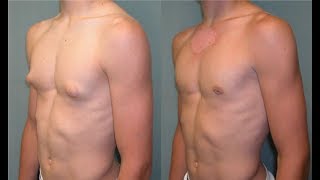 gynecomastia treatment without surgery [upl. by Anul871]