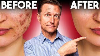 The FASTEST Way to Rid Acne  Dr Berg [upl. by Leveroni113]