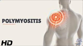 Polymyositis Understanding the Rare Autoimmune Disease [upl. by Nueovas]