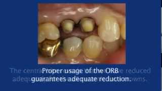 The Occlusal Reduction Bur  Demonstration of Use [upl. by Ahsenal]