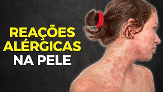 DERMATITE DE CONTATO  EVITE E TRATE REAÇÕES ALÉRGICAS NA PELE [upl. by Von807]