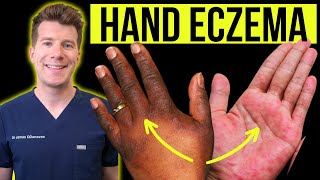 Doctor explains how to recognise and treat HAND ECZEMA dermatitis  Causes symptoms amp prevention [upl. by Dominga]