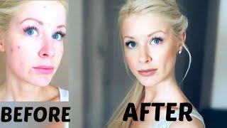 FLAWLESS Foundation Routine  Acne Coverage [upl. by Sib]