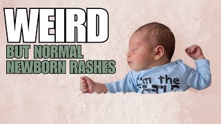 Newborn Baby Rashes on Face and Skin [upl. by Law]