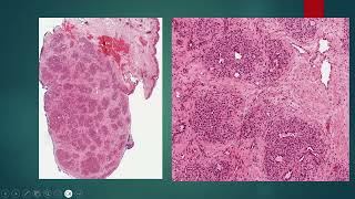 2024 09 16 Lobular Capillary Hemangioma Pyogenic Granuloma [upl. by Buerger608]