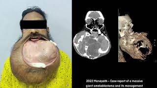 ameloblastoma convencional [upl. by Copeland]