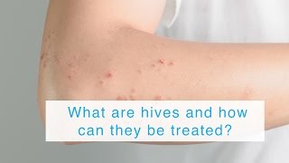 What are hives and how can they be treated [upl. by Snowman742]