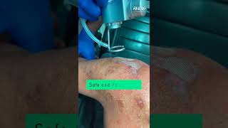 LASER TREATMENT FOR KELOID [upl. by Alur133]