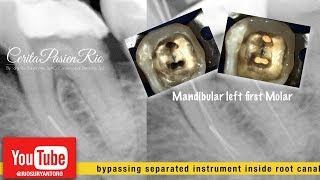 bypassing instrument in endodontic treatment  perawatan akar gigi  endodontist [upl. by Presber]