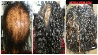 Alopecia And Crochet Braids  Freetress Go Go Curl [upl. by Lertram]