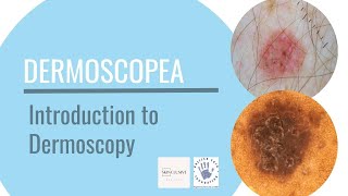 Introduction to Dermoscopy [upl. by Carothers]