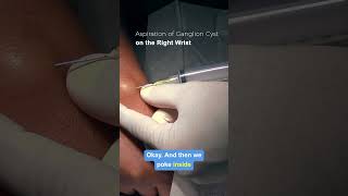 Aspiration of Ganglion Cyst hospital meded medical medicine doctor resident medicalstudent [upl. by Ramirolg949]