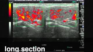 Hashimotos thyroiditisPower Doppler ultrasound [upl. by Amimej]