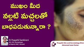 ముఖం మీద నల్లటి మచ్చలతో బాధపడుతున్నారా  facial melanosis  Dr Pragathi  Dermatologist  Nizamabad [upl. by Jeffcott]