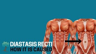 What Causes Diastasis Recti  Diastasis Ed 3 [upl. by Carnahan671]