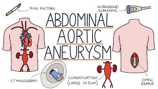 Understanding Abdominal Aortic Aneurysms [upl. by Kevina]