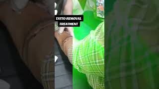 TATTO REMOVAL TREATMENT cosmetologists hairtreatmentexperts doctor dermatologist interview [upl. by Llevol]