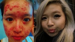 My Acne Story  Accutane FAQ [upl. by Ataga]