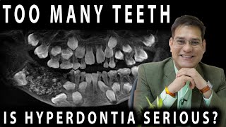 Hyperdontia Symptoms Causes Treatment  Can Too Many Teeth Cause You Serious Problems  EXTRATOOTH [upl. by Dutch]