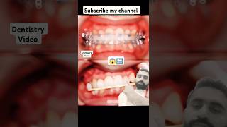 Cross bite braces 😱braces orthodontist dentist dentistry dentalbraces [upl. by Yahsel363]