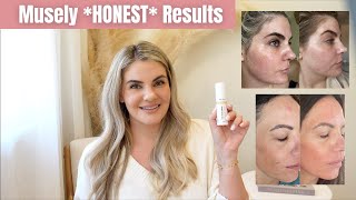 Musely The Spot Cream  Did it work on my melasma [upl. by Anihc]