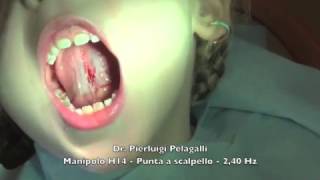 Frenulectomia Linguale con Laser FOTONA ErYAG  Dr Pierluigi Pelagalli [upl. by Koziarz913]