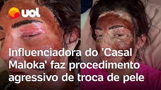 Influenciadora do Casal Maloka faz procedimento agressivo de peeling e troca de pele vídeo [upl. by Dnalra]