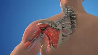 Posterior Cervical Decompression Surgery  Medical animation video [upl. by Aserat677]