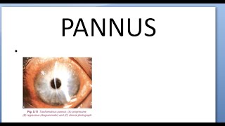 Ophthalmology Pannus Progressive Regressive Total Corneal Blinding Sequalae Difference Causes [upl. by Ruella]