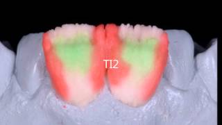 Technique de stratification ZIRPRESS  Emax Ivoclar [upl. by Studley]