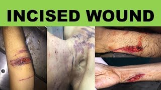 INCISED WOUND Characteristic features and Medicolegal importance [upl. by Ottilie307]