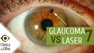 Glaucoma X Laser parte 7  Como a Iridotomia pode afetar um sintoma do glaucoma [upl. by Josselyn]