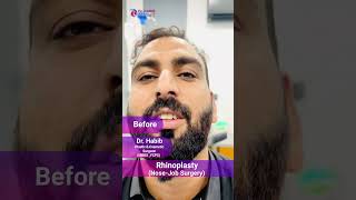 Rhinoplasty Before amp After Result  Amazing Transformation [upl. by Jelks]