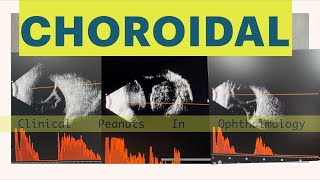 Choroidal Detachment  Haemorrhagic Vs Serous Atlas of B scan [upl. by Lsil]