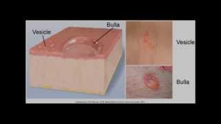 different type skin lesions and their morphology macule papule vesicle pustule [upl. by Asiruam65]