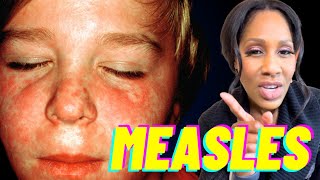 MEASLES Symptoms Treatments amp Vaccination 😱Do You Need a Measles Booster [upl. by Eemak279]