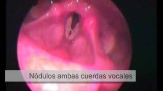 Lesiones en cuerdas vocales y laringe [upl. by Lekar]