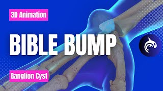 Learn about Bible Bumps Ganglion Cysts in 3D [upl. by Eide]