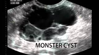 Monster Cyst [upl. by Cazzie]