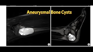 Aneurysmal Bone Cyst  The Bone Thats Alive [upl. by Auhesoj]