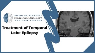 Treatment of Temporal Lobe Epilepsy [upl. by Edwina]