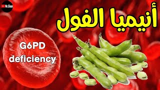 G6PD deficiency انيميا الفول favism 🫛🫘 [upl. by Letch]