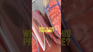 What is this procedure Video credit Prof Dr Sedat Belli YouTube Thanks for this video [upl. by Llywellyn784]