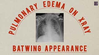 PULMONARY EDEMA vs SARCOIDOSIS  THE BATWING APPEARANCE HOW TO IDENTIFY [upl. by Vanderhoek576]