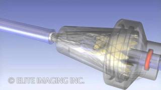 Loading Heart Valve Catheter  Medical amp Scientific Video Production [upl. by Lemhar]